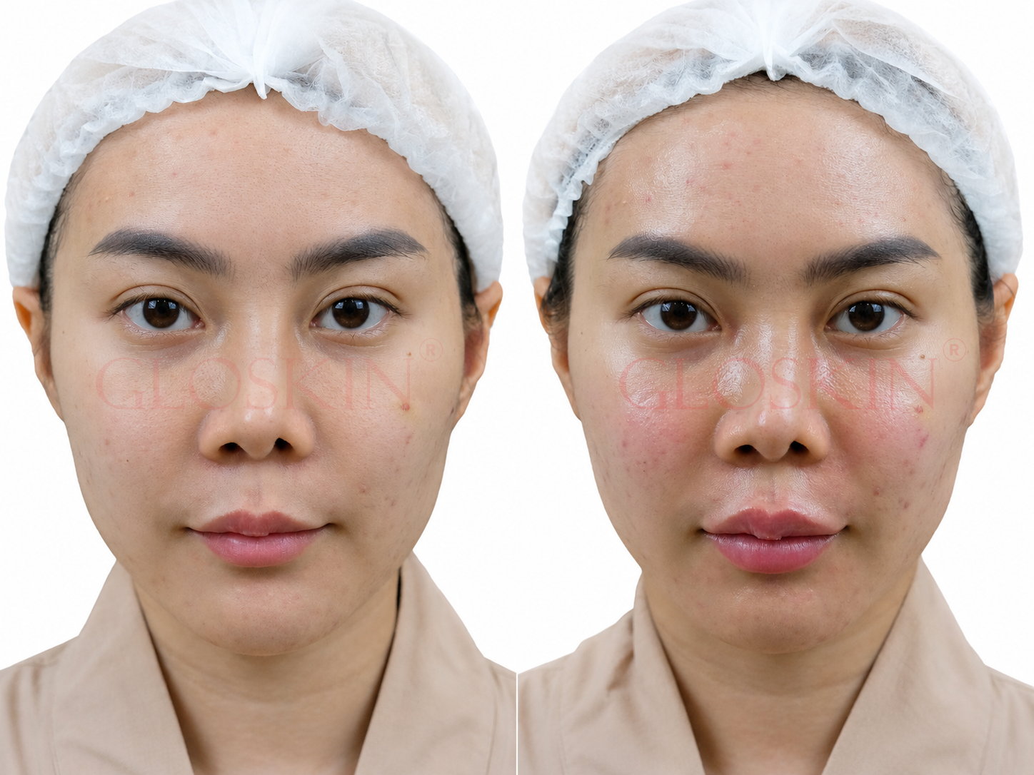 Face Contour Juvederm
