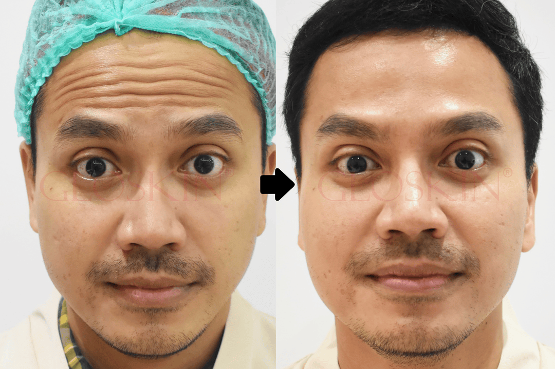 BOTOX
