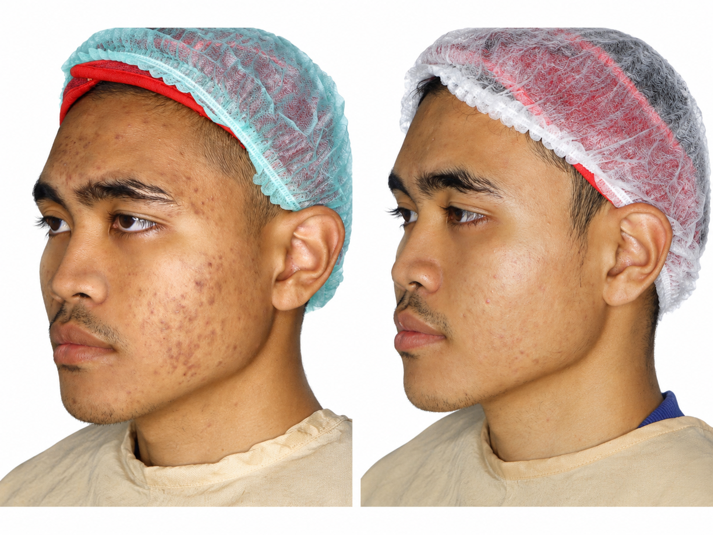 Exoskin - Gambar 2