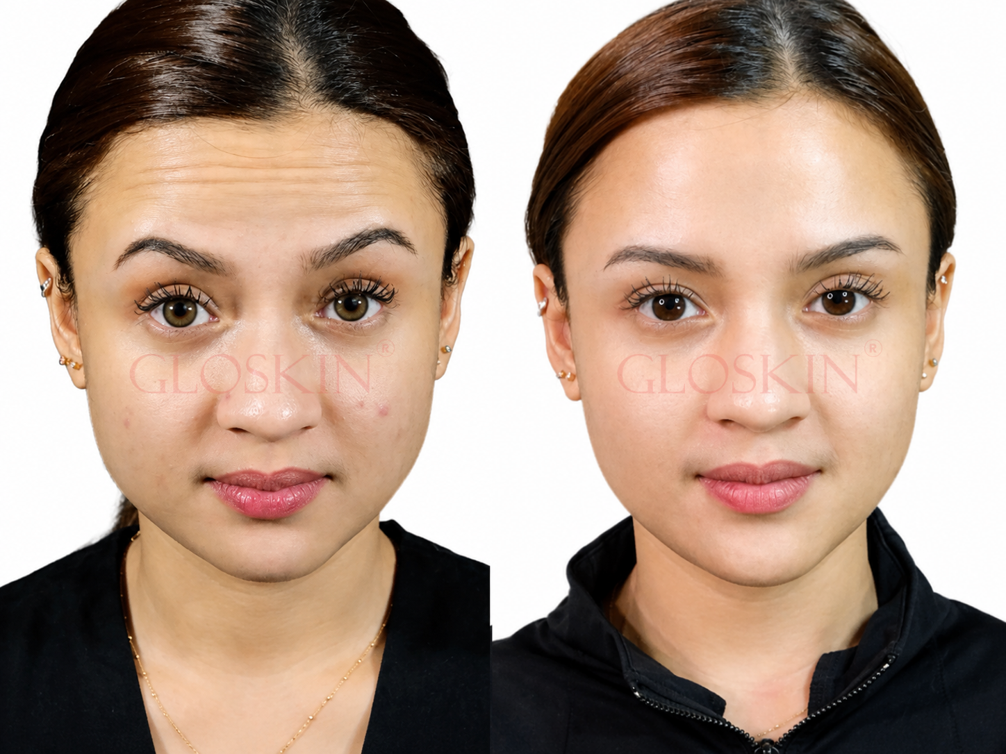 BOTOX - Gambar 2