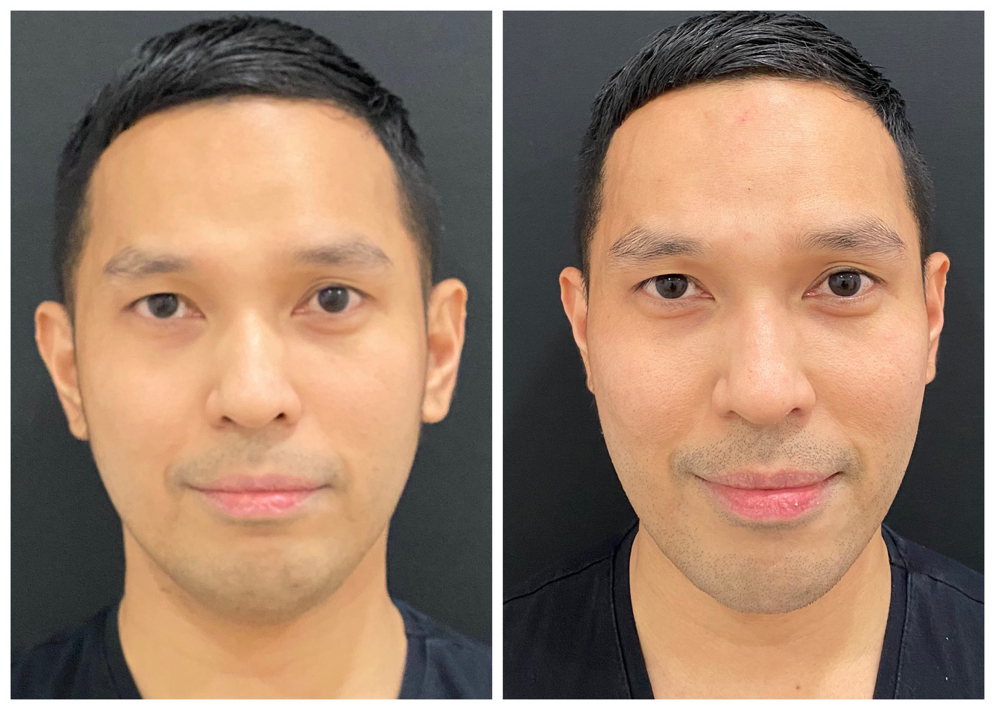 Face Contour Juvederm - Gambar 3
