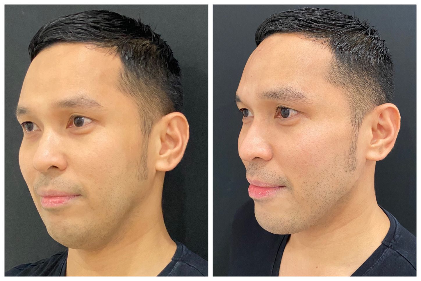 Face Contour Juvederm - Gambar 2