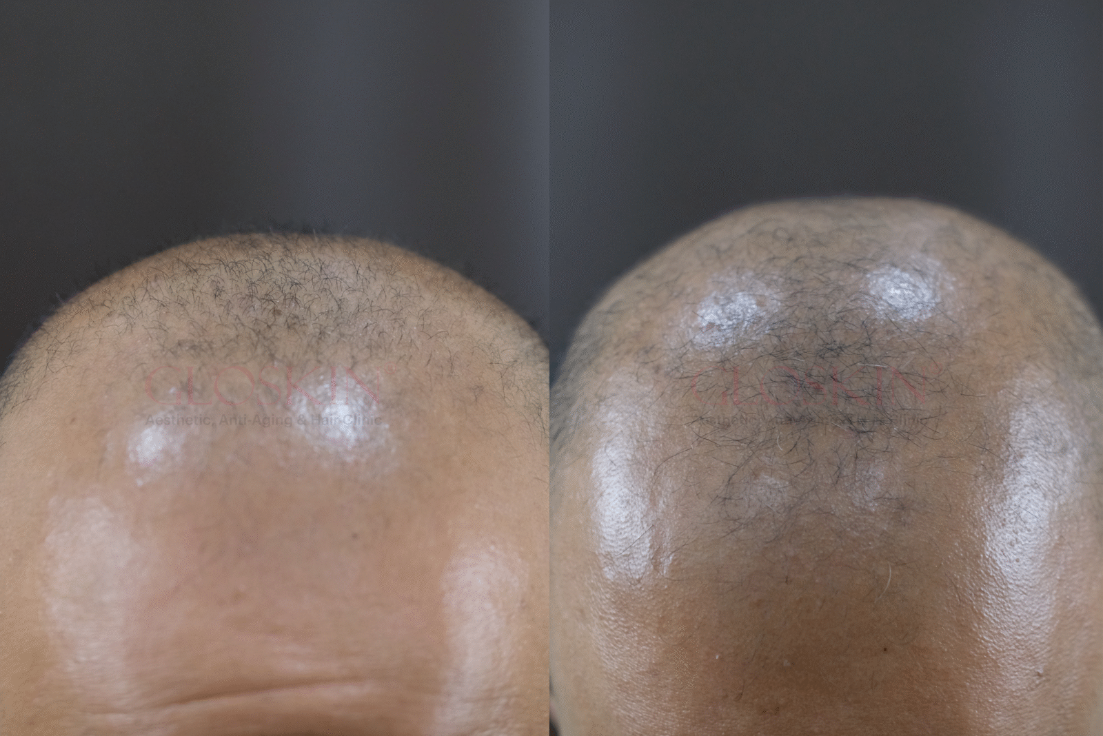 Hair Restoration — Gloskin