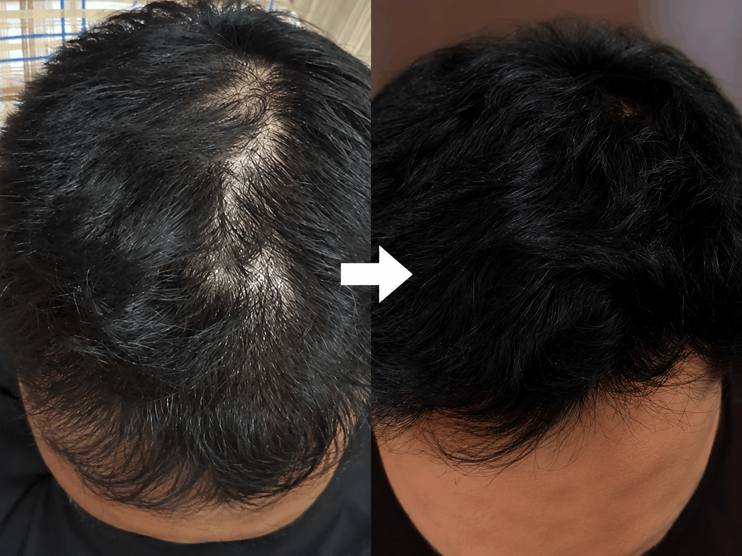 PRP Hair - Gambar 2