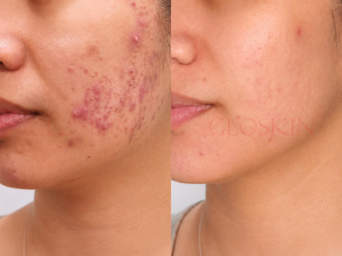 Acne Spot Injection