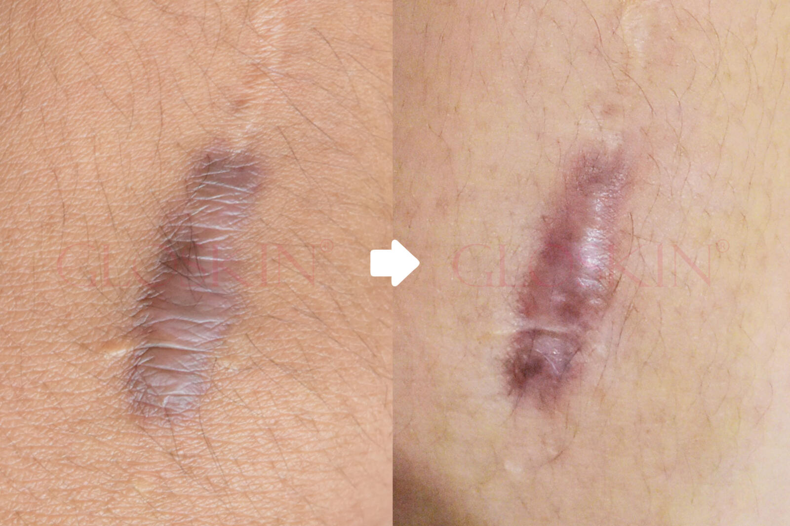 Keloid Injection