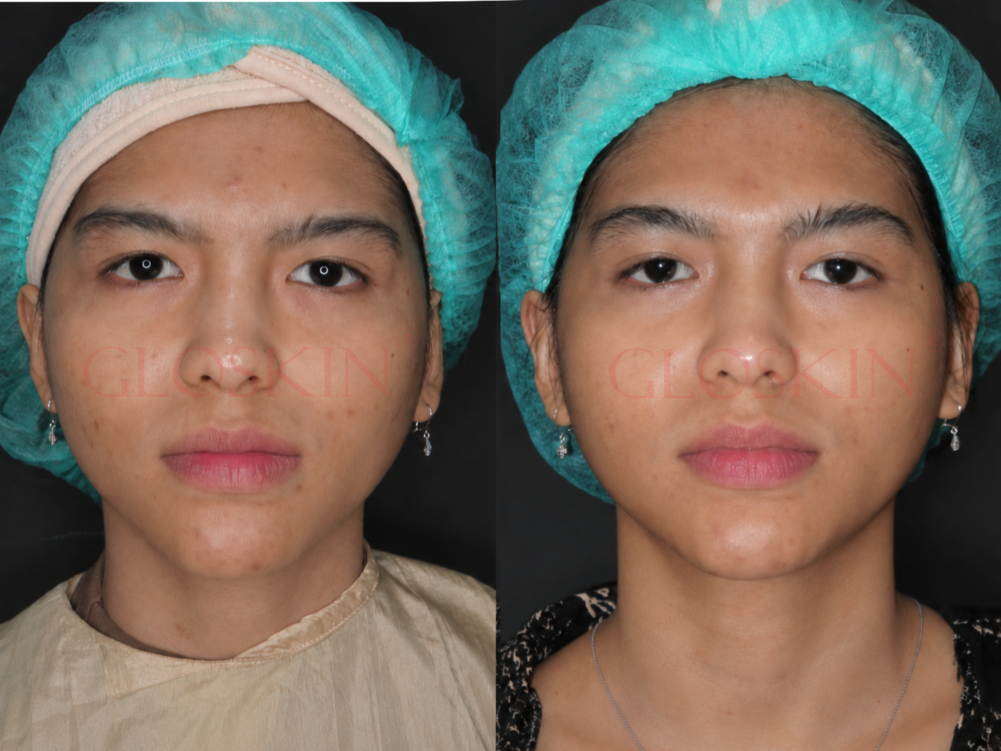 Acne Advance Peeling