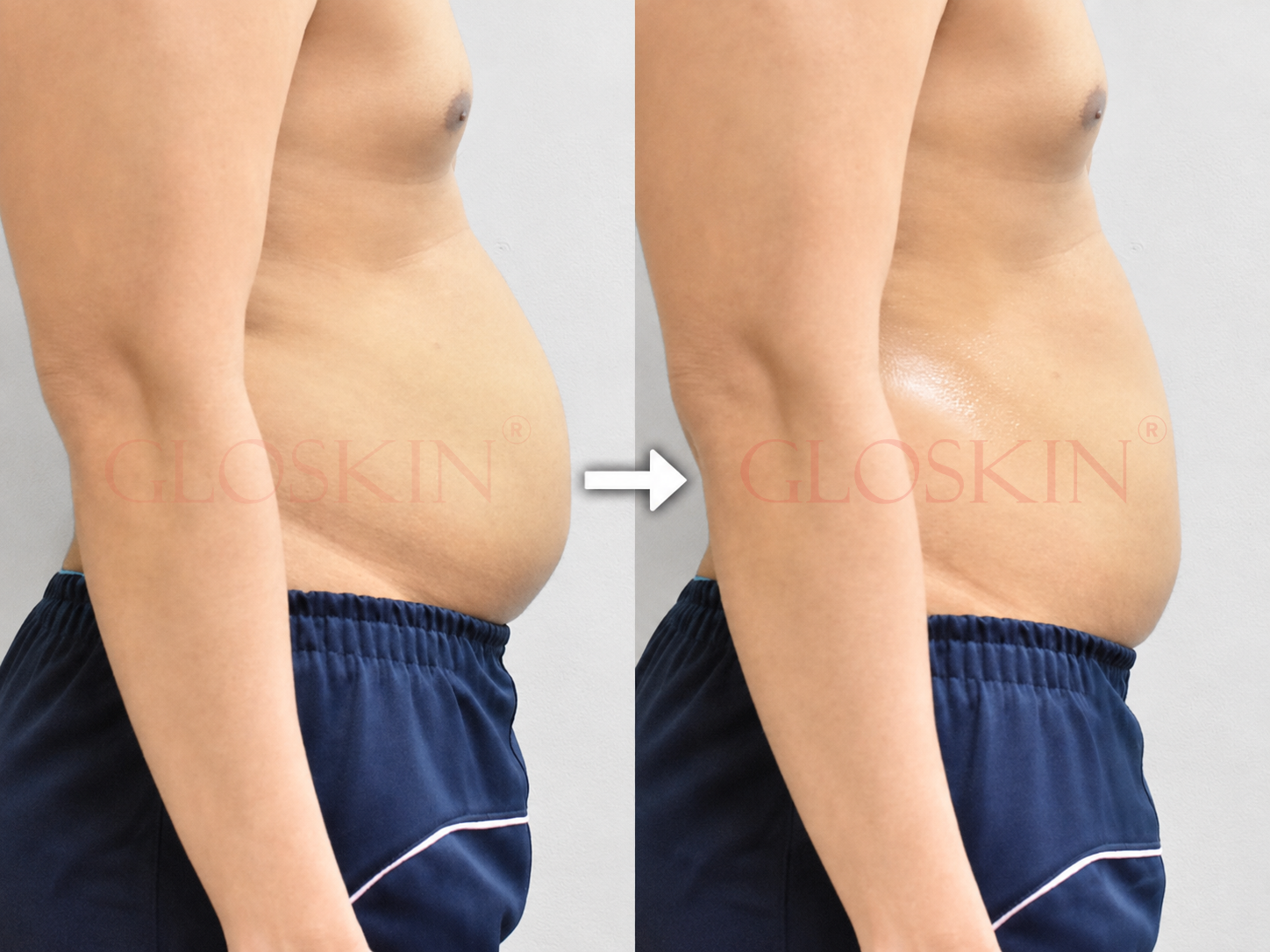Hollywood Body Sculpting