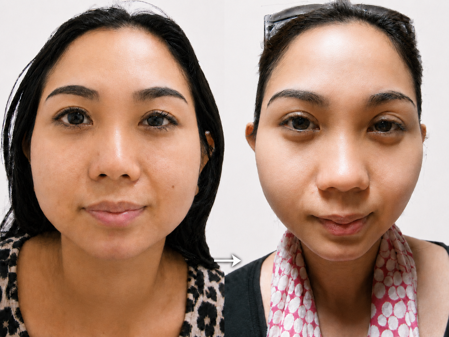Chubby Cheek & Double Chin - Gambar 3