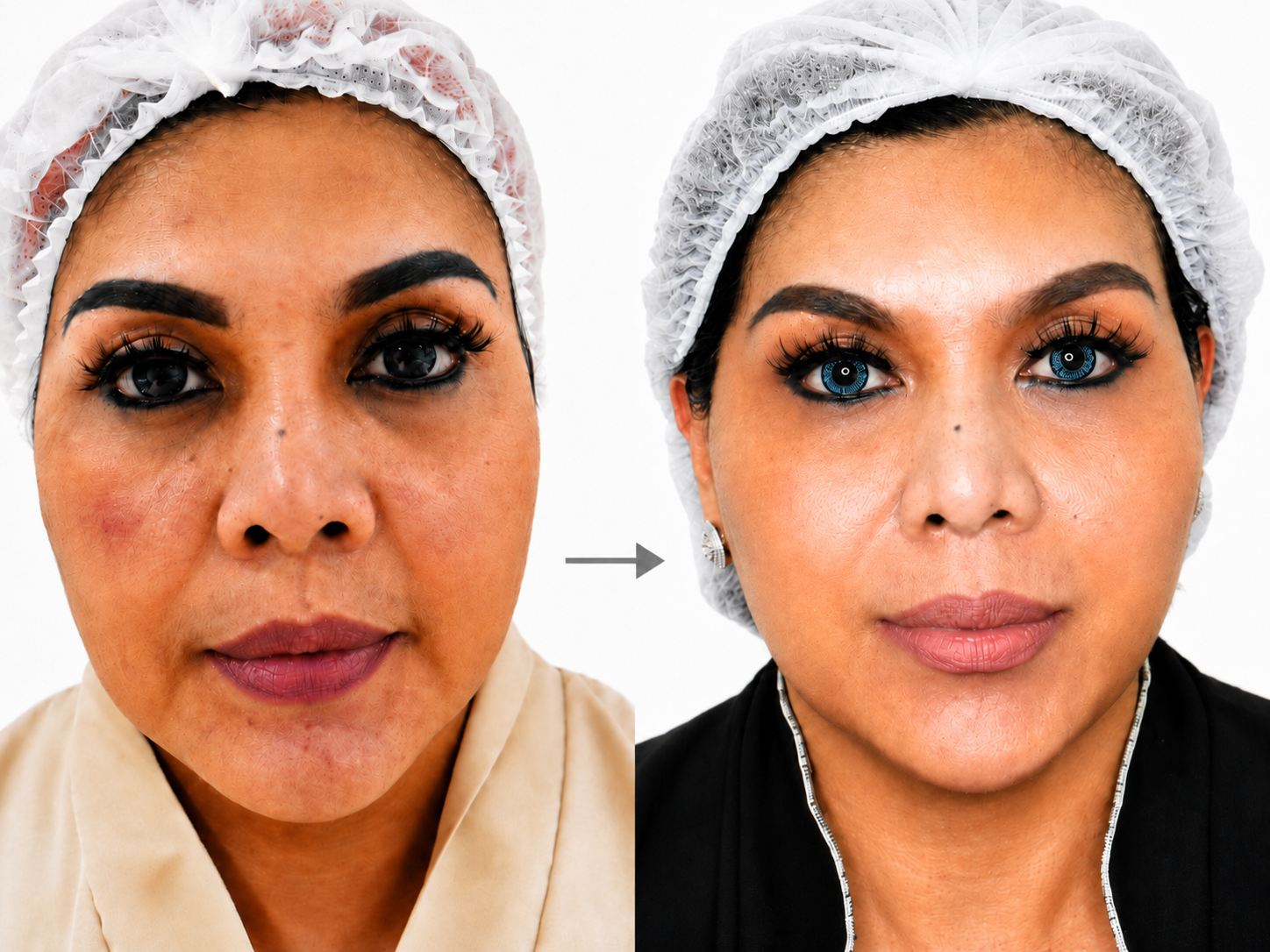Chubby Cheek & Double Chin - Gambar 2