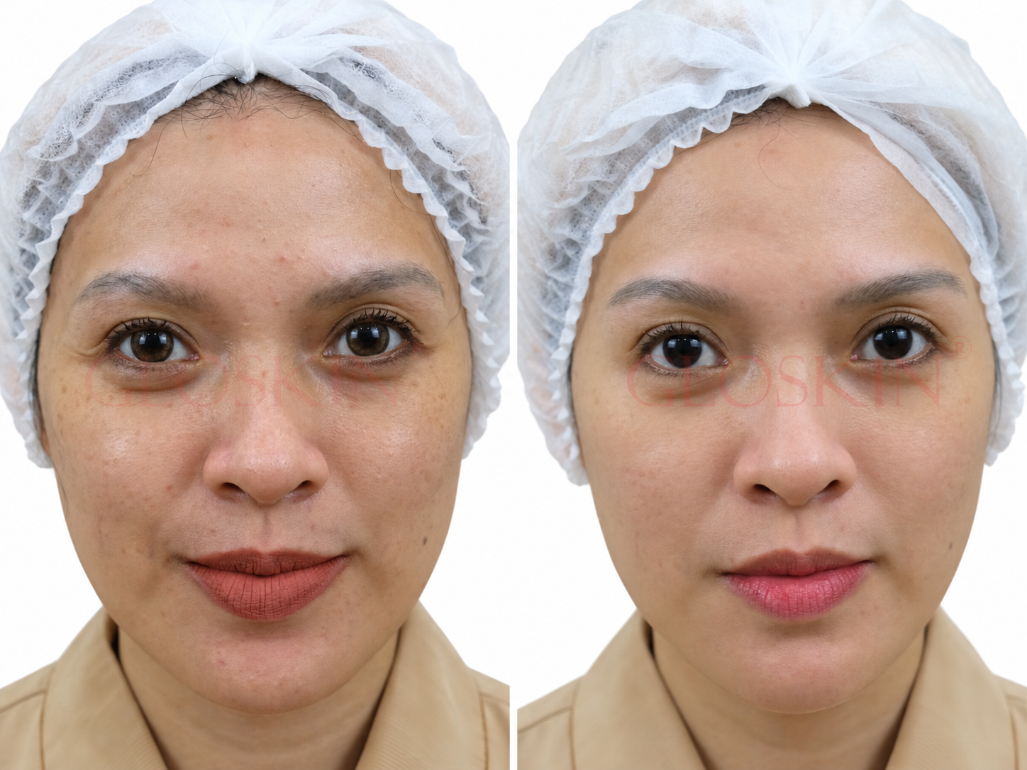 Derma Oxy Facial Therapy