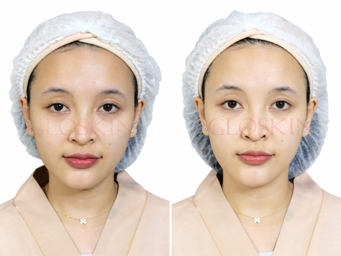 Skin Barrier Facial Therapy