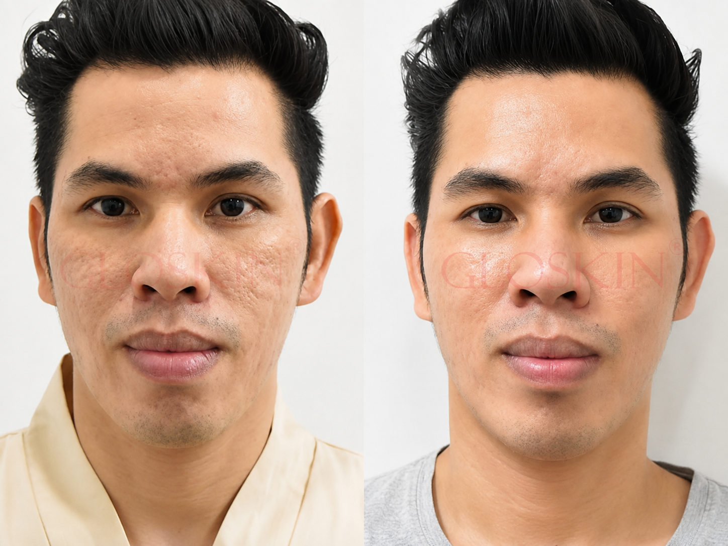 Acne Blue Light Peel