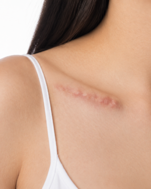 KELOID REMOVAL