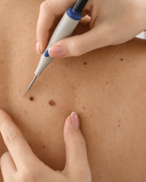 SKIN TUMOR REMOVAL